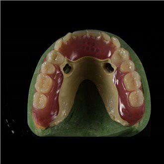 पीक फ्रेमवर्क डेंचर