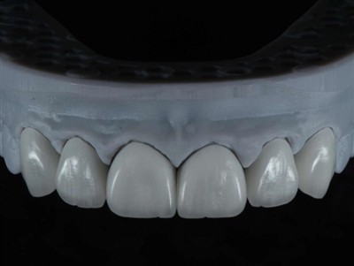 विदेश में डेंटल लैब तकनीशियन के काम को आउटसोर्स कैसे करें: एक व्यापक गाइड