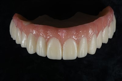 एक्रिलिक राल अस्थायी क्राउन